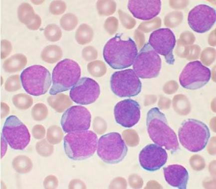 Células de Leucemia